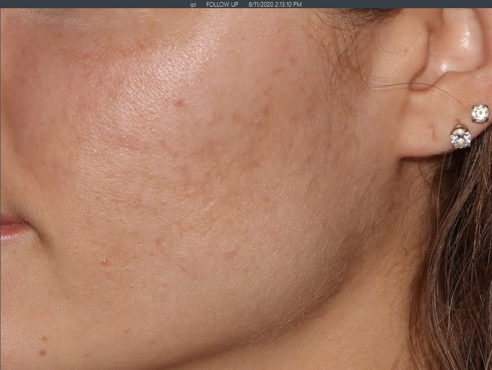 After Charcoal Facial