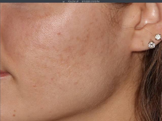 After Charcoal Facial