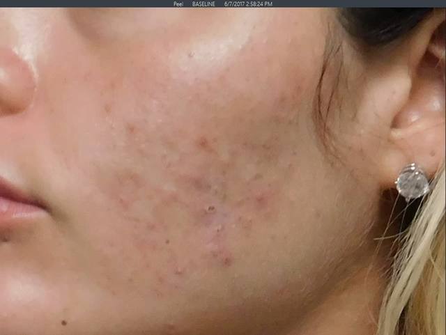 Before Charcoal Facial