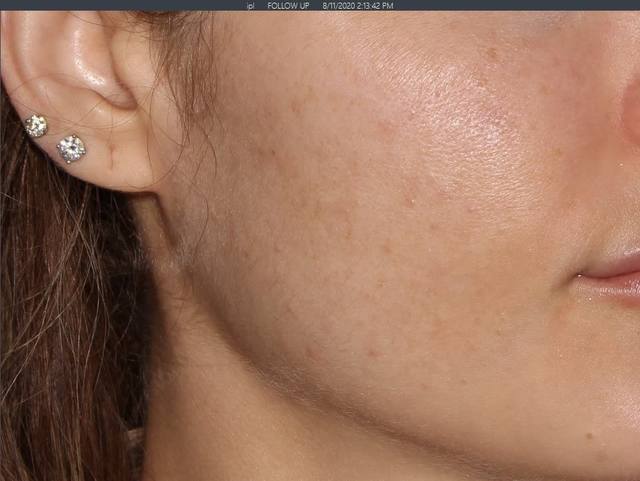 After Charcoal Facial