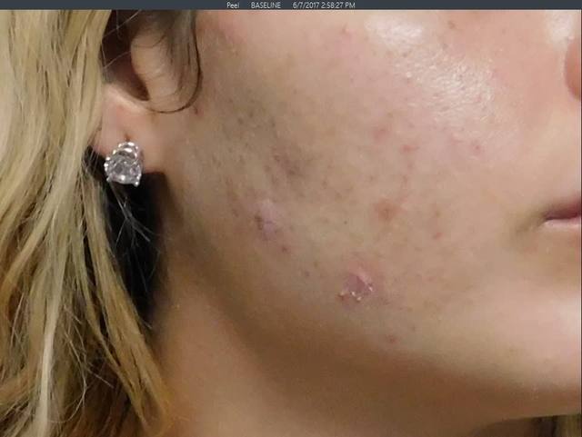 Before Charcoal Facial
