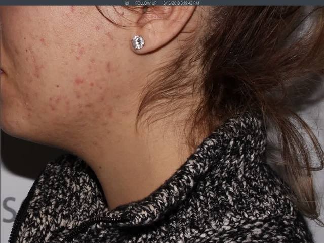 After Chemical Peel