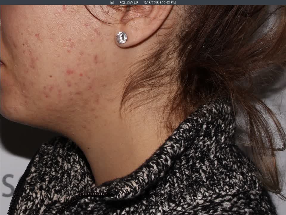 After Chemical Peel