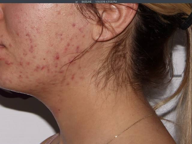 Before Chemical Peel