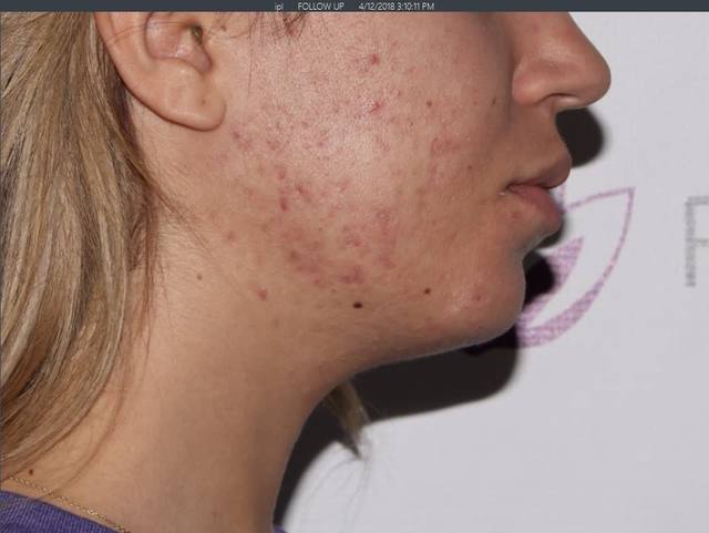 After Chemical Peel