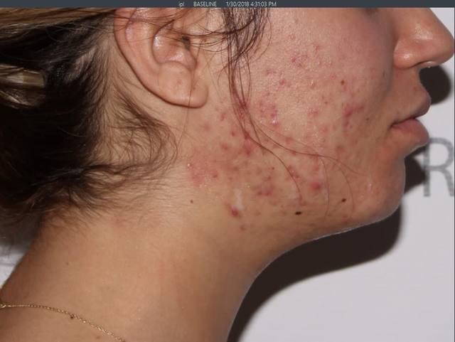 Before Chemical Peel