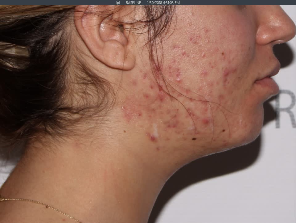 Before Chemical Peel