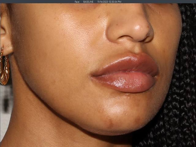 After Pigment Correction