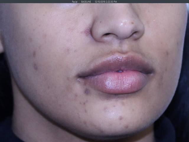 Before Pigment Correction