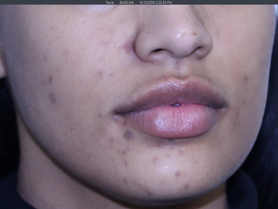 Before Pigment Correction