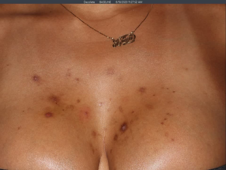 Before Pigment Correction