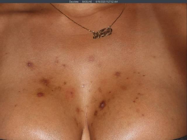 Before Pigment Correction