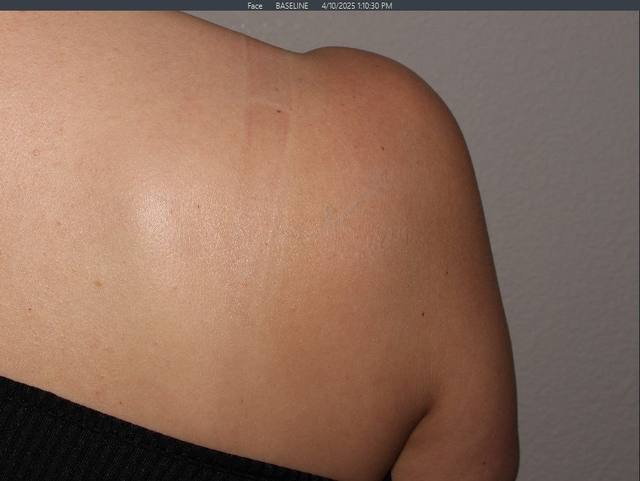 After Tattoo Removal