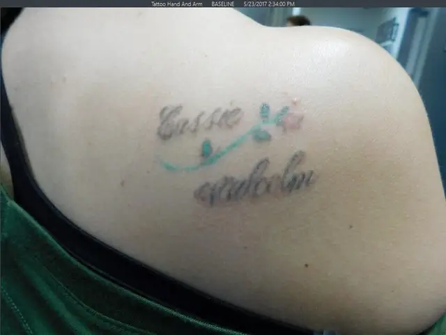 Before Tattoo Removal