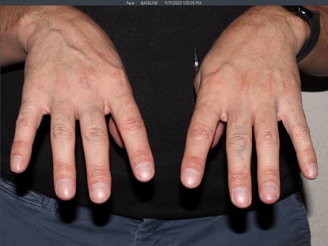 After Tattoo Removal