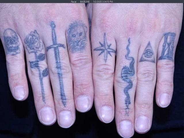 Before Tattoo Removal