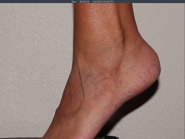 After Tattoo Removal