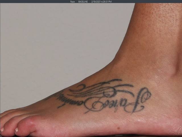 Before Tattoo Removal