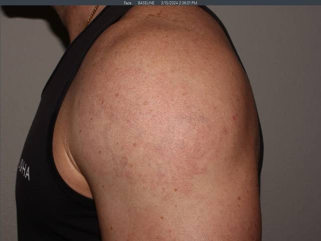 After Tattoo Removal