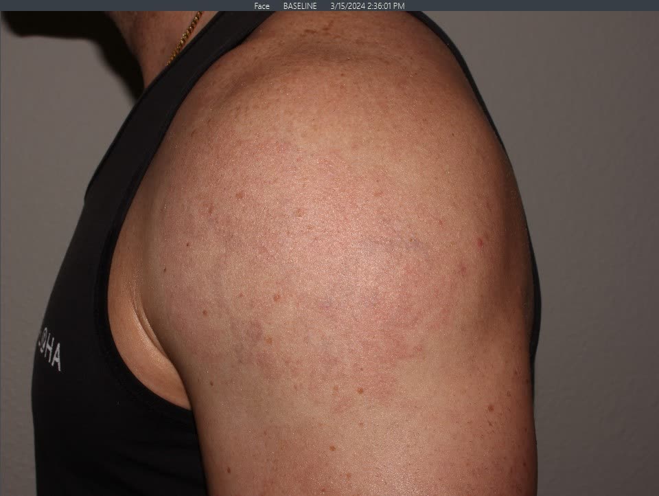 After Tattoo Removal