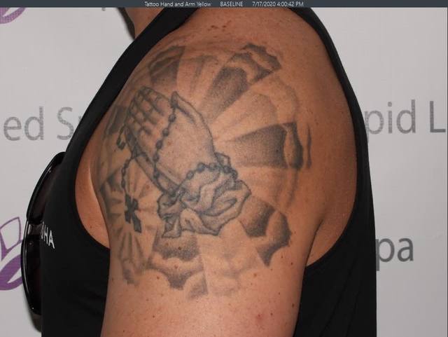 Before Tattoo Removal