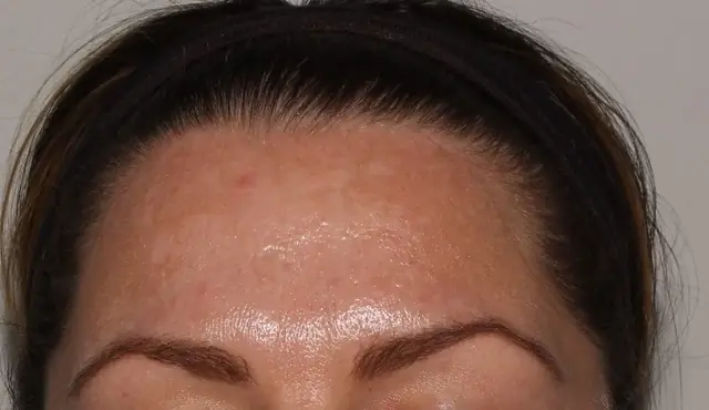 Before PiQo4 Toning